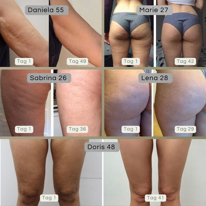 ShineGlow-Cellulite-Massagegerät