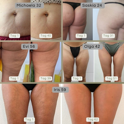 ShineGlow-Cellulite-Massagegerät